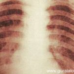 tuberculoza